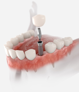 Dental Implants